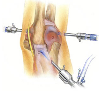Артроскопия колена
