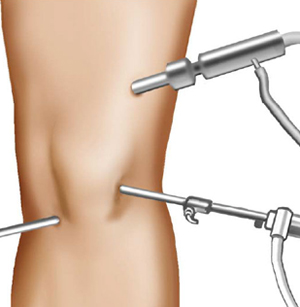 Операция на коленном суставе