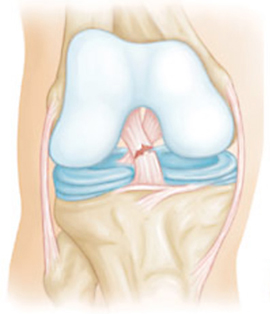 Повреждение коленных связок